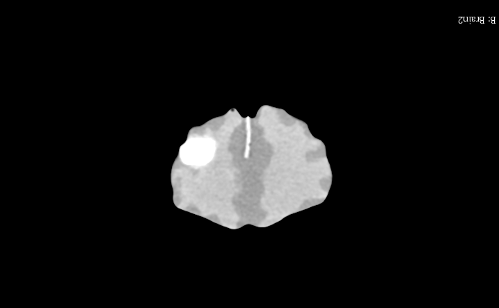 CT Scans