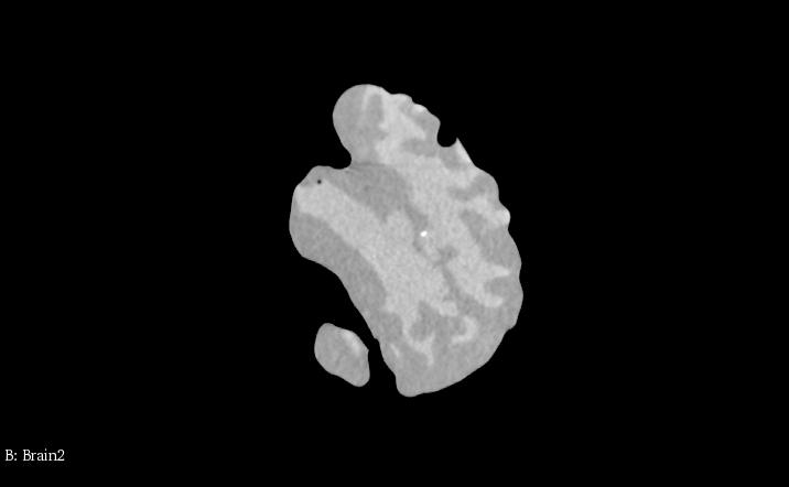 CT Scans