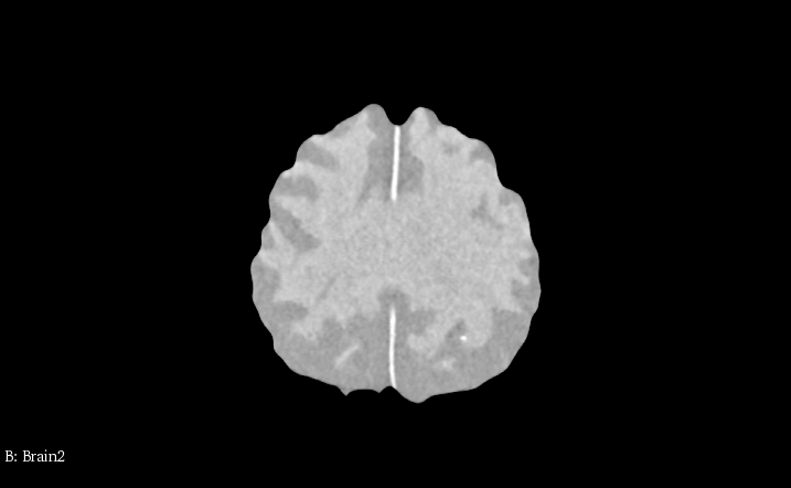 CT Scans