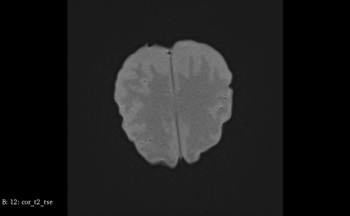 MRI Scans