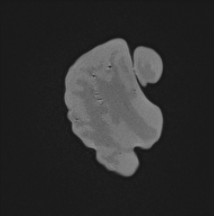 MRI Scans