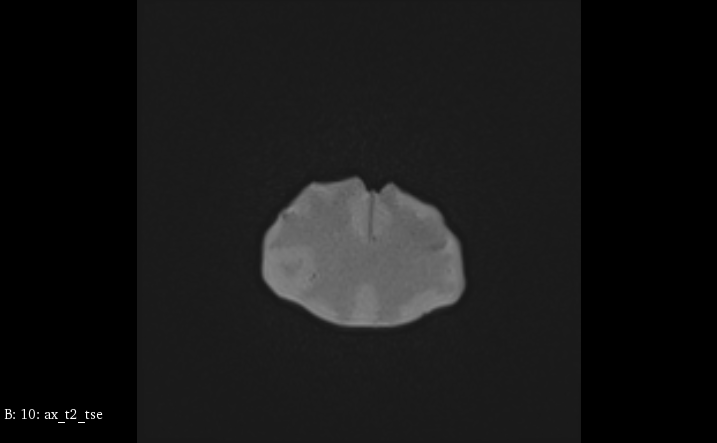 MRI Scans