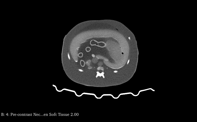 CT Scans