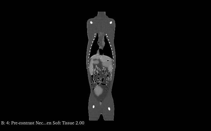 CT Scans