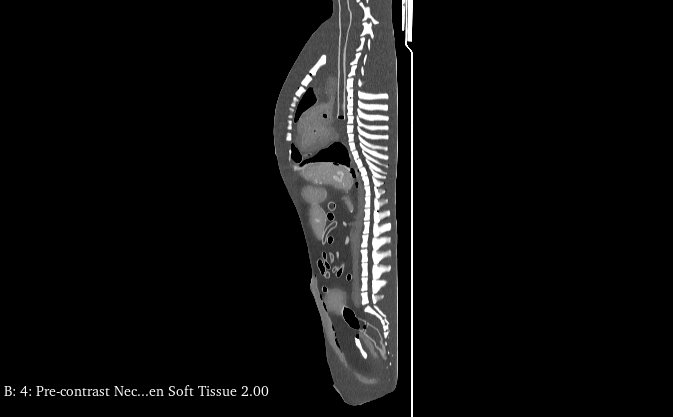 CT Scans