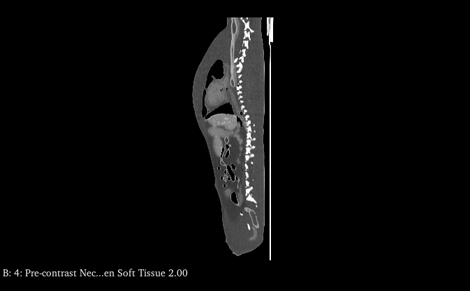 CT Scans