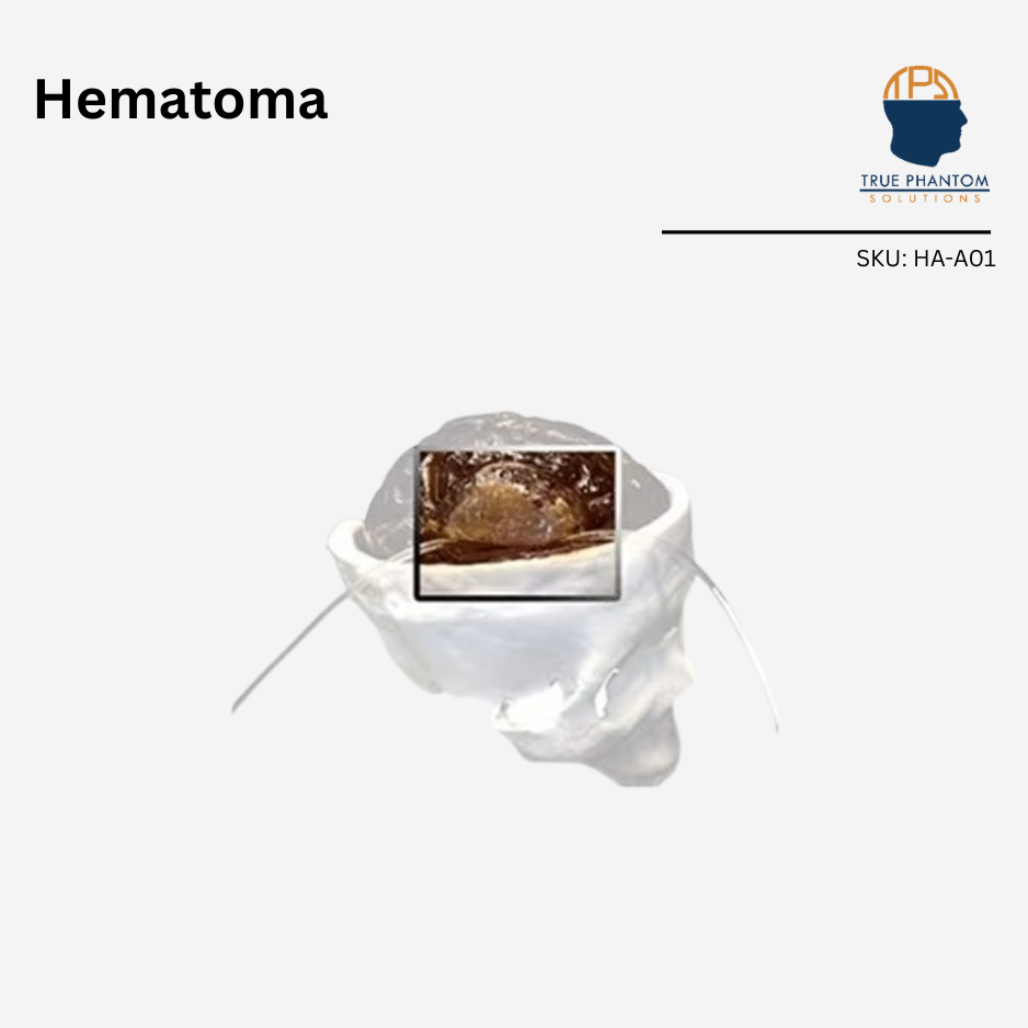 Hematoma